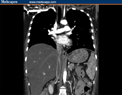IVC thrombus seen in coronal computed tomography.