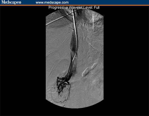 IVC venogram demonstrating IVC filling defect, superior to right renal vein, secondary to thrombus; also visualized are Optease IVC filter and catheter in distal right renal vein.