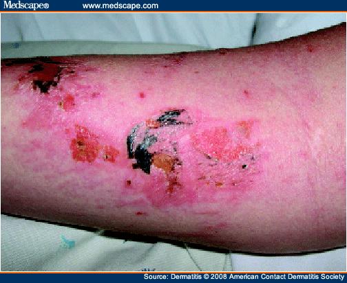 Patient's left volar forearm, with black spots and erythematous plaques with edema, vesiculation, and ulceration.