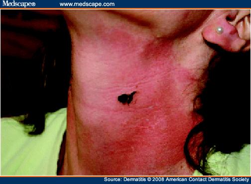 Black spots, erythema, and edema of the anterior neck. 