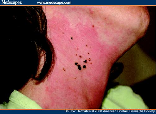 Black spots, erythema, and edema of the anterior neck. 