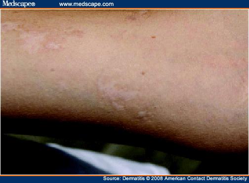 Scarring on left forearm at sites of black-spot poison ivy dermatitis. 