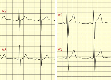 Intriguing ECG Primer Offers Clear Introduction to Resting ECG Concepts